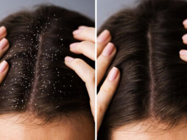 a scalp with dandruff, and a healthy scalp