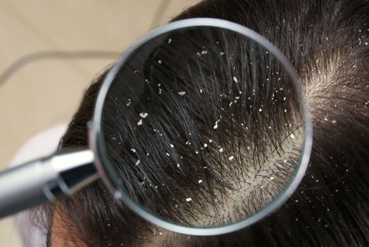scalp with dandruff before scalp treatment